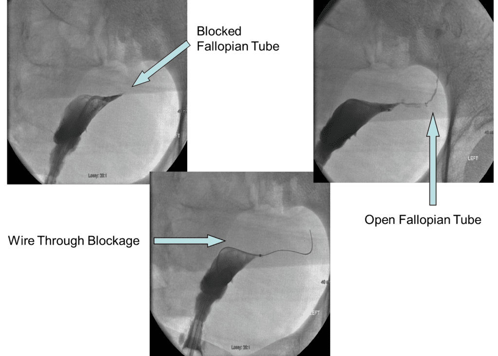 Fallopian Tube X-Ray