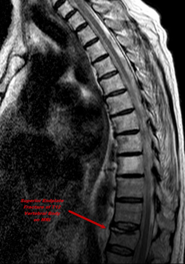 T12 Vertebral Fracture on MRI