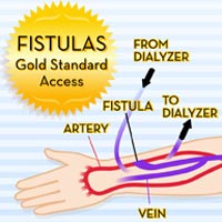 Fistula Gold Standard Access